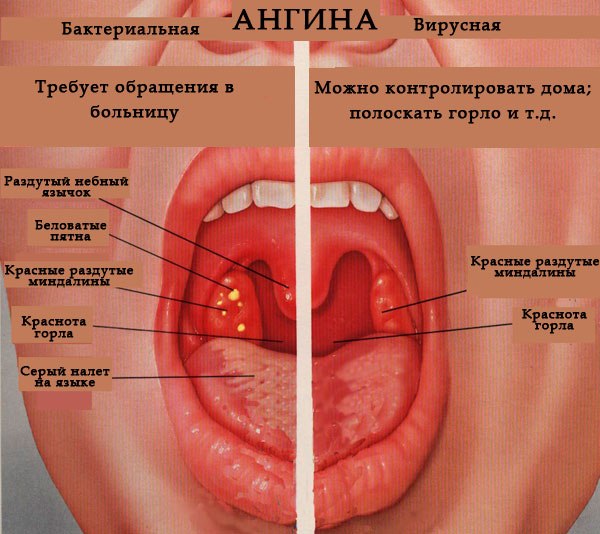 Лечение ангины и воспалений горла без антибиотиков