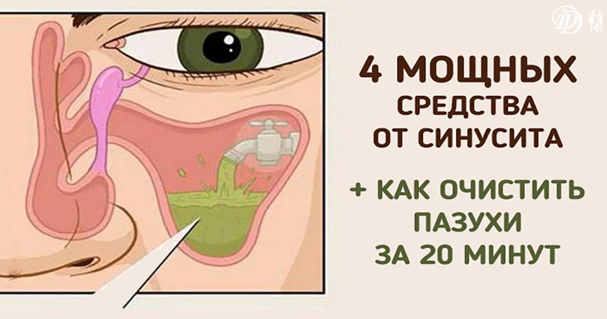 Как в домашних условиях очистить гайморит Как в домашних условиях очистить гайморит