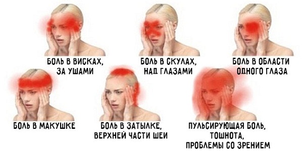 5 предупредительных сигналов: о чем говорит боль в разных частях головы?