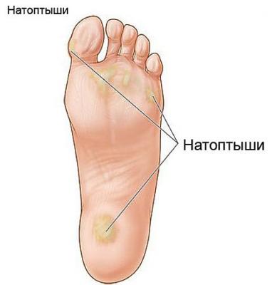 Моментально избавится от натоптышей и мозолей!