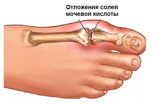 Как снизить содержание мочевой кислоты в организме?