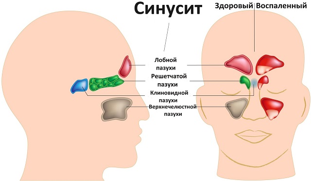 Избавьтесь от воспаления носовых пазух в течение 20 секунд с помощью этого простого метода, и всего одного ингредиента!