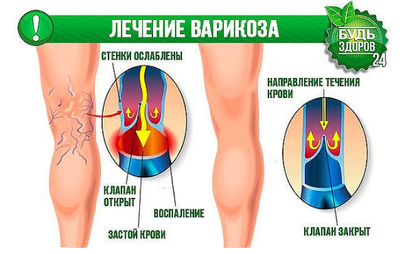 У вас проблемы с венами? Попробуйте эту мазь!