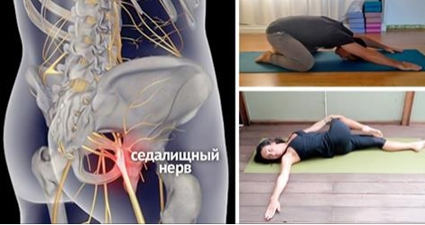 8 простых упражнений, которые помогут избавиться от защемления седалищного нерва!