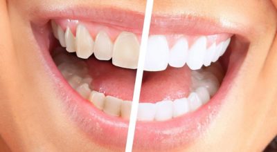 Улыбка на миллион: как отбелить зубы в домашних условиях за 3 минуты