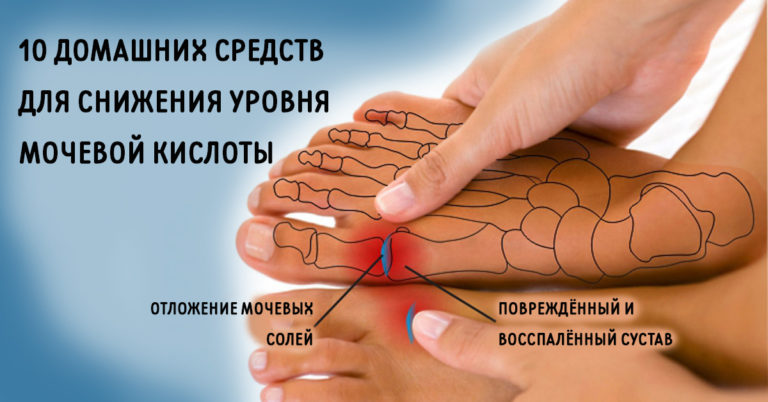 ИЗБАВЬСЯ от мочевой кислоты и вылечи подагру! 10 натуральных средств!