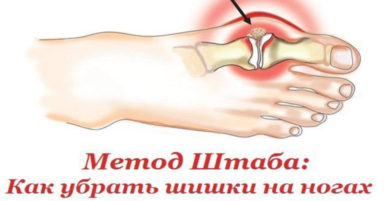 Вот это да! Эффективный метод Н.Н. Штаба избавит от болезненной шишки на ноге!