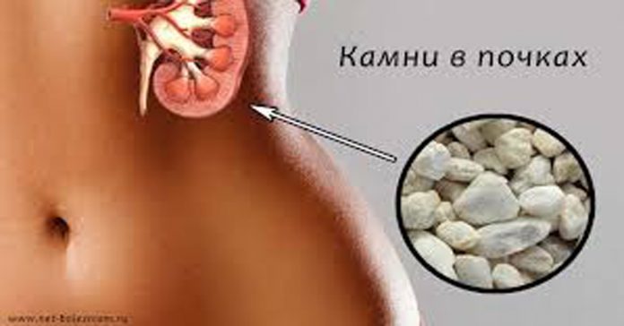С этим лекарством камни в почках и желчном «растают»! Врачи рекомендуют!