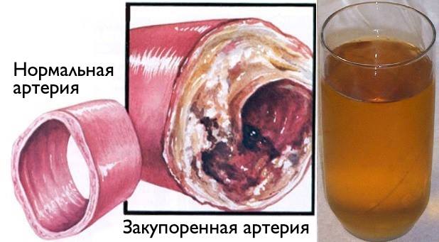 Очистите кровеносные сосуды с помощью всего одного стакана этого напитка!