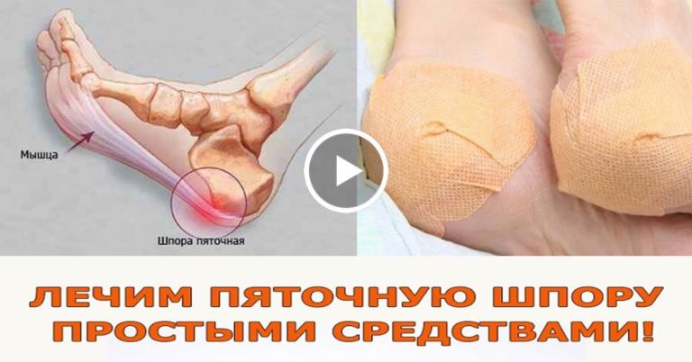 Мега средство! Избавит от пяточной шпоры мгновенно!