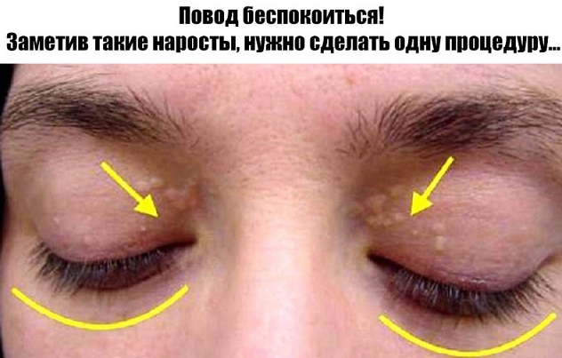 Желтоватые наросты на веках глаз! Раньше я думала, что это всего лишь косметическая проблема, некрасивость, которую должен удвлять врач. Оказалось, всё гораздо, гораздо серьезнее…