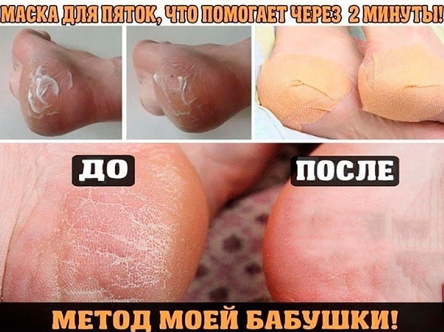 Домашнее СРЕДСТВО ДЛЯ ВАШИХ ПЯТОЧЕК! ПОМОГАЕТ ЗА МИНУТУ!