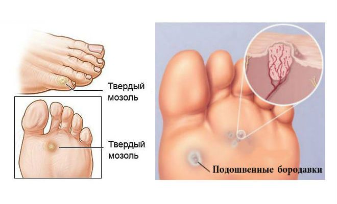 Мозоли и бородавки на ногах: как от них избавиться? Лучший способ, который действительно работает!