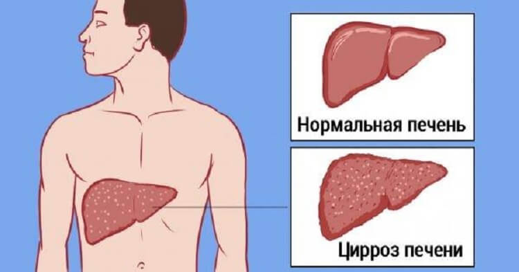 Мы травим свою печень одним привычным продуктом! Настоящая гадость…
