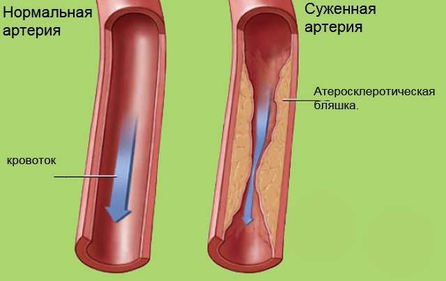 Очищение сосудов. Лучшие методики