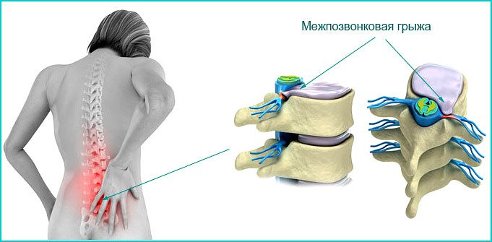 ПОЯСНИЧНАЯ ГРЫЖА ЛЕЧИТСЯ НАРОДНЫМИ СПОСОБАМИ