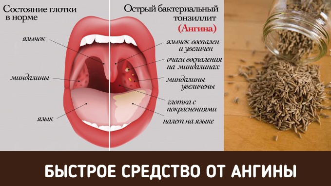 Как избавиться от боли в горле за пару часов?