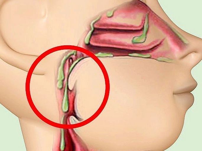 Средства, которые избавят от насморка, гайморита, кашля всего за 24 часа!