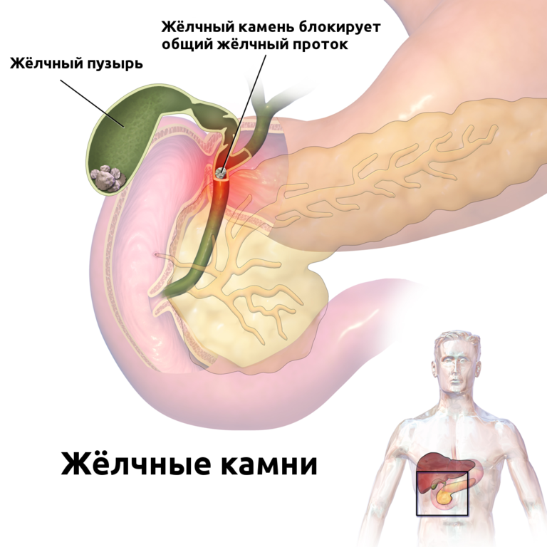 Китайский способ избавиться от всех желчных камней за неделю
