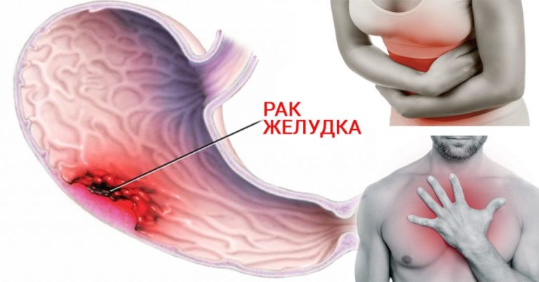 СИМПТОМЫ, КОТОРЫЕ МОГУТ БЫТЬ РАННИМИ ПРИЗНАКАМИ РАКА ЖЕЛУДКА