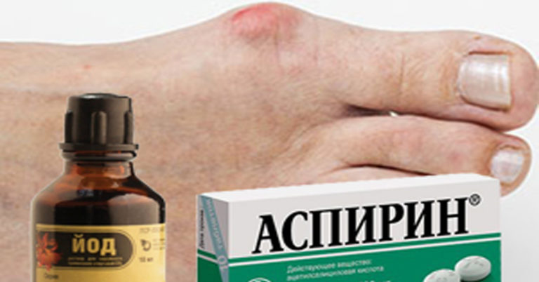 Народными способами быстро убираем косточку на ноге